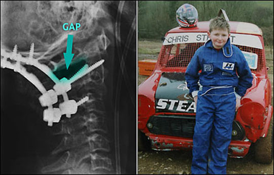 Miracle ... an x-ray of Chris's neck showing surgical head supports and, right, boy racer Chris poses by his mini
